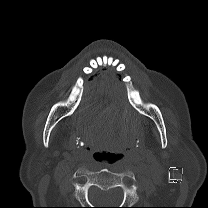 Bilateral palatine tonsilloliths on OPG and CT (Radiopaedia 75167-86247 Axial bone window 45).jpg