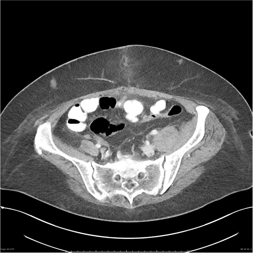 Bilateral psoas hematomas (Radiopaedia 24057-24279 A 66).jpg
