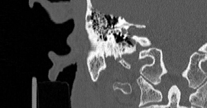 File:Bilateral temporal bone fractures (Radiopaedia 29482-29970 Coronal non-contrast 118).jpg