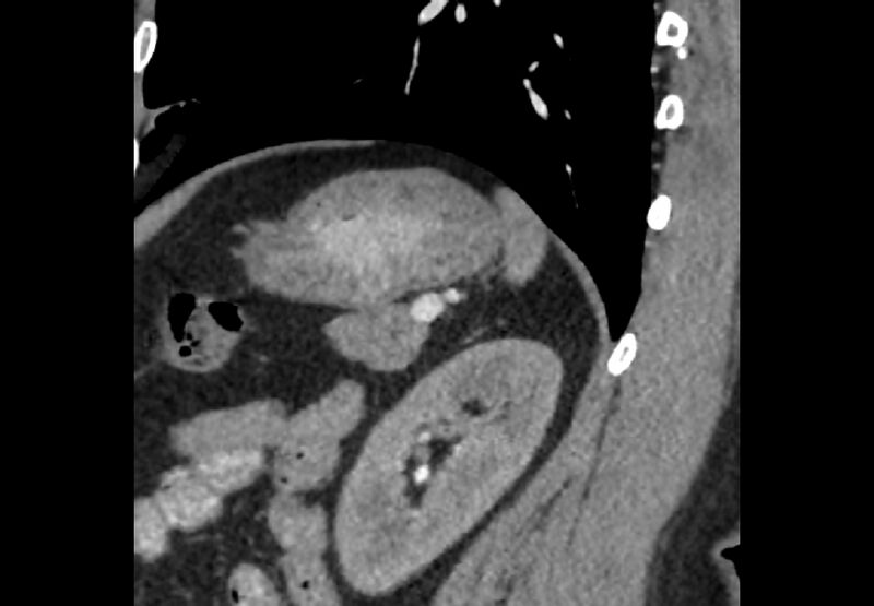 File:Bilateral urolithiasis with incidentally detected splenic artery aneurysm and left inferior vena cava (Radiopaedia 44467-48127 Ob. Sag. C+ Art. 13).jpg