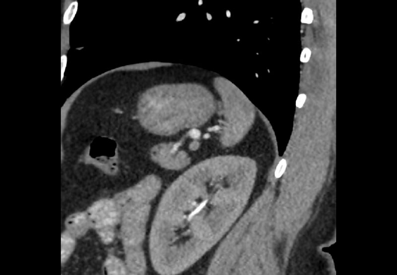 File:Bilateral urolithiasis with incidentally detected splenic artery aneurysm and left inferior vena cava (Radiopaedia 44467-48127 Ob. Sag. C+ Art. 5).jpg