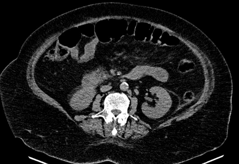 File:Biliary pancreatitis (Radiopaedia 72289-82823 Axial non-contrast 132).jpg