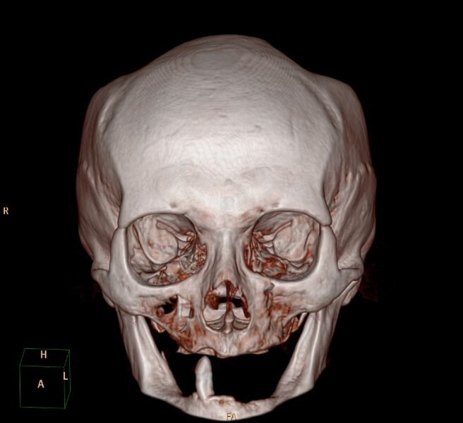 File:Biparietal osteodystrophy (Radiopaedia 46109-50463 3D 3D VR 1).jpg