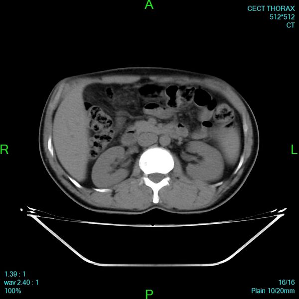 File:Bone metastases from lung carcinoma (Radiopaedia 54703-60937 Axial non-contrast 15).jpg