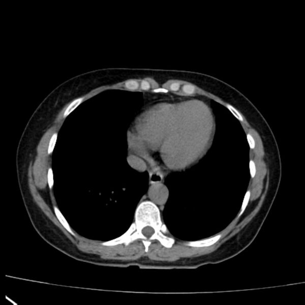 File:Bosniak renal cyst - type I (Radiopaedia 27479-27675 Axial non-contrast 4).jpg
