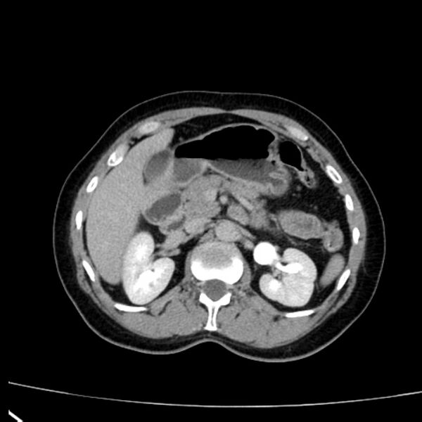 File:Bosniak renal cyst - type I (Radiopaedia 27479-27675 D 13).jpg