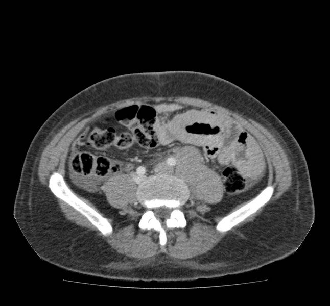 File:Bowel lymphoma complicated by bleeding after therapy (Radiopaedia 55601-62107 A 54).jpg