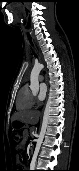 File:Brachiocephalic trunk pseudoaneurysm (Radiopaedia 70978-81191 C 52).jpg