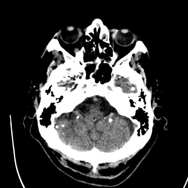 File:Brain Pantopaque remnants (Radiopaedia 78403-91048 Axial non-contrast 28).jpg
