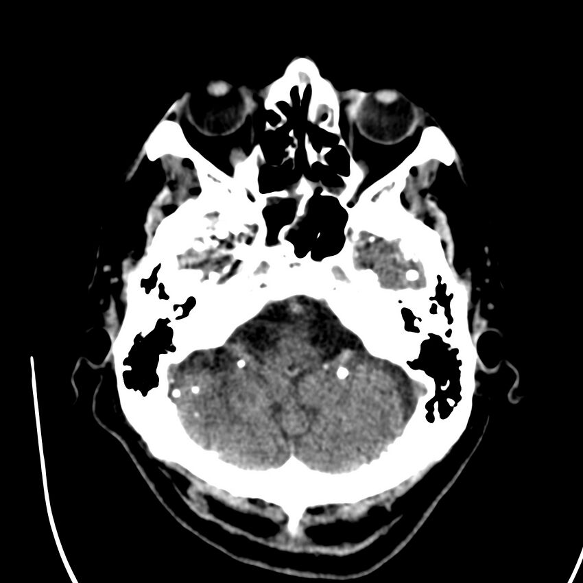 Brain Pantopaque remnants (Radiopaedia 78403-91048 Axial non-contrast 28).jpg