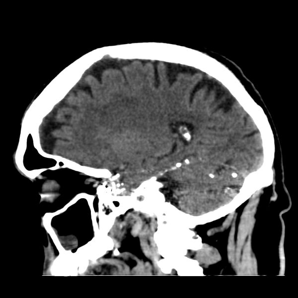 File:Brain Pantopaque remnants (Radiopaedia 78403-91048 C 37).jpg
