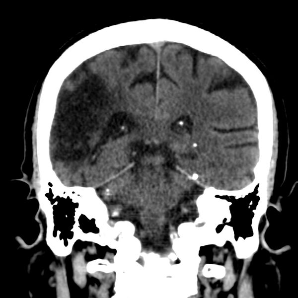 File:Brain Pantopaque remnants (Radiopaedia 78403-91048 Coronal non-contrast 45).jpg