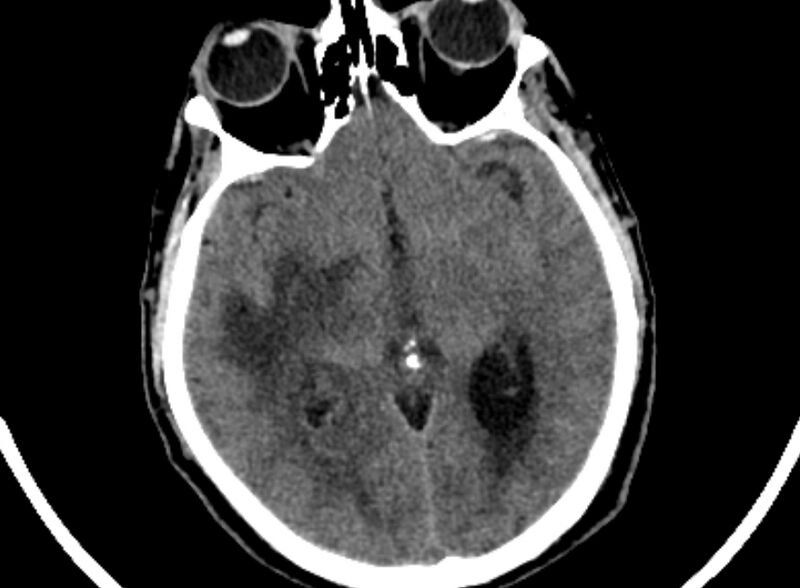 File:Brain abscess complicated by intraventricular rupture and ventriculitis (Radiopaedia 82434-96575 Axial non-contrast 31).jpg