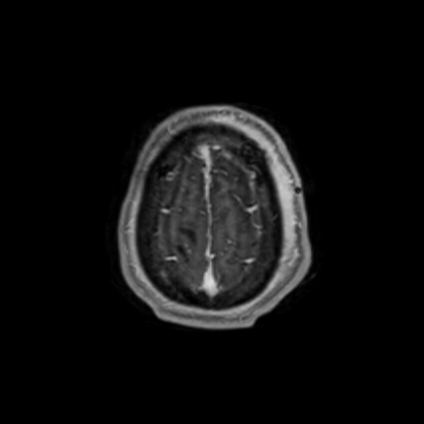 Brain abscess complicated by intraventricular rupture and ventriculitis (Radiopaedia 82434-96577 Axial T1 C+ 65).jpg