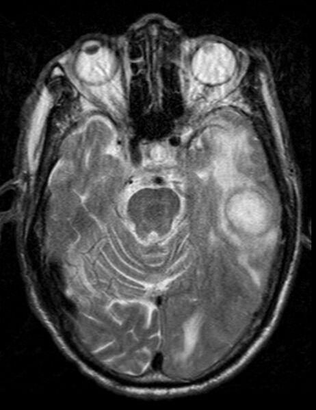 File:Brain abscess with dual rim sign (Radiopaedia 87566-103938 Axial T2 7).jpg