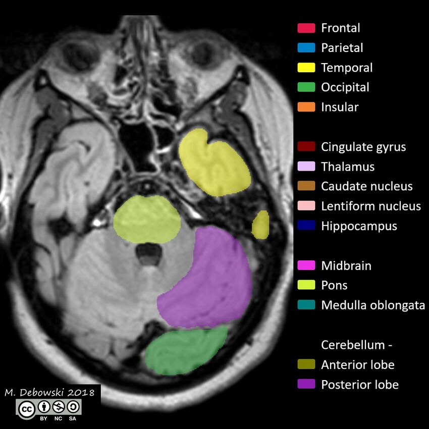Brain lobes - annotated MRI (Radiopaedia 61691-69700 Axial 58).JPG
