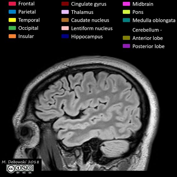 File:Brain lobes - annotated MRI (Radiopaedia 61691-69700 Sagittal 12).JPG