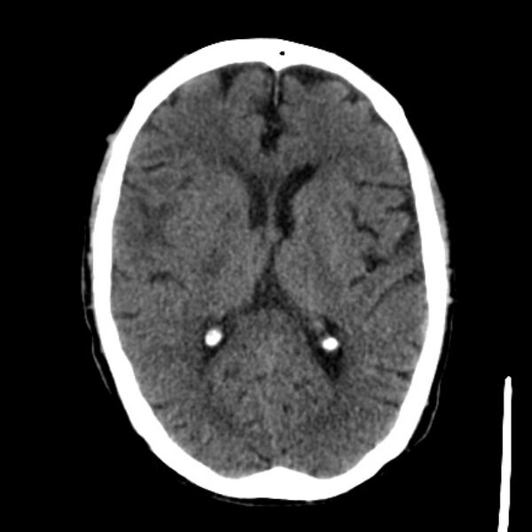 File:Brain metastases from lung cancer (Radiopaedia 27849-28092 Axial non-contrast 25).jpg