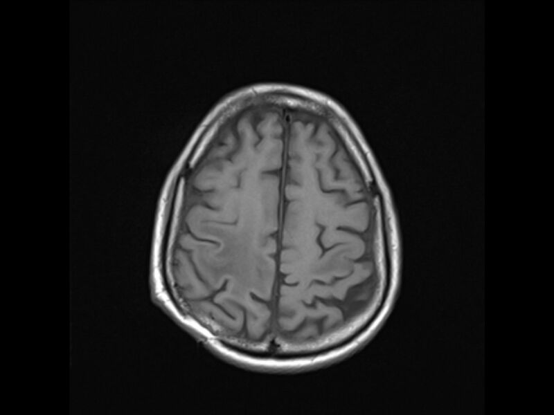File:Brain metastases from renal cell carcinoma (Radiopaedia 42222-45297 Axial T1 20).jpg