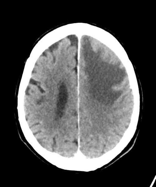 File:Brain metastasis (lung cancer) (Radiopaedia 48289-53177 Axial C+ 23).png