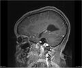 Brainstem glioma (Radiopaedia 21819-21775 D 12).jpg