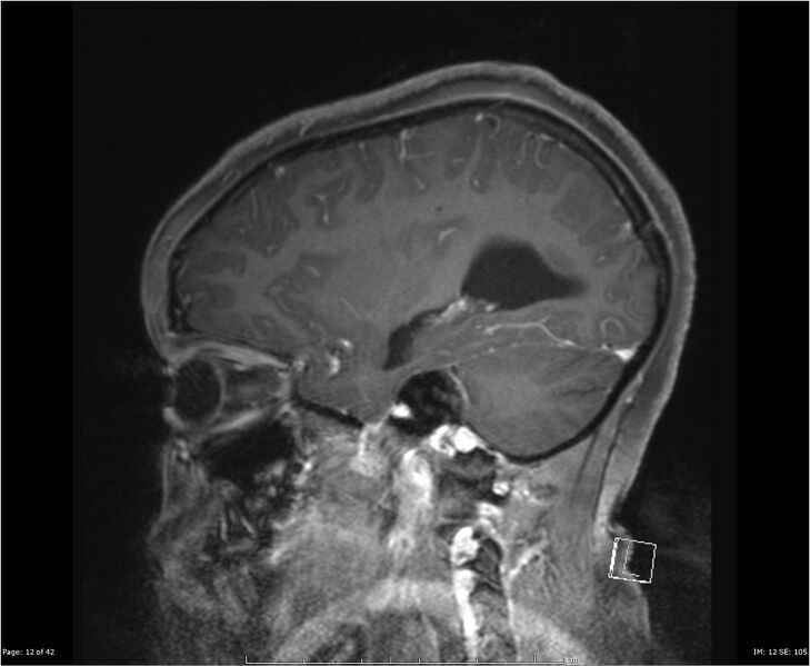 File:Brainstem glioma (Radiopaedia 21819-21775 D 12).jpg