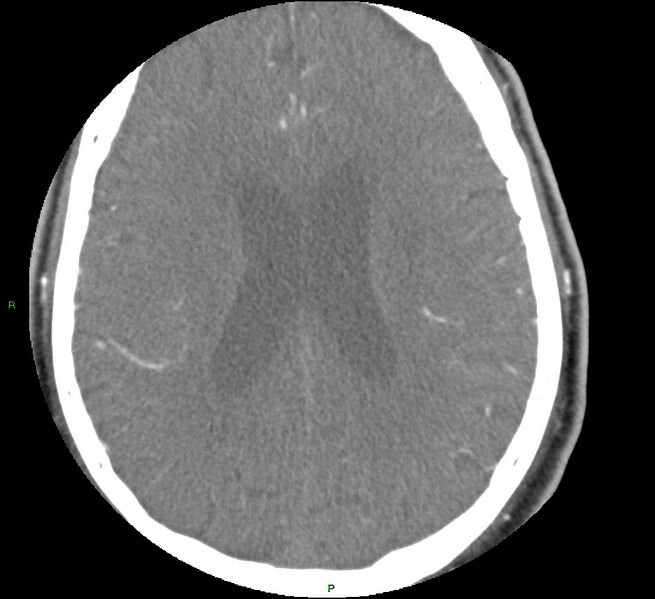 File:Brainstem hemorrhage (Radiopaedia 58794-66028 D 123).jpg