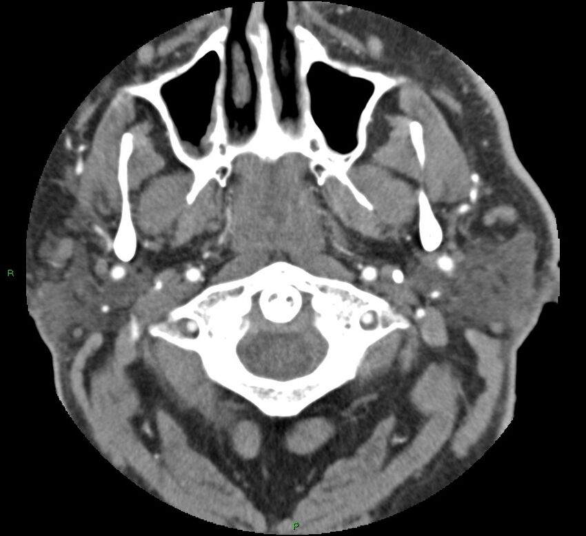 Brainstem hemorrhage (Radiopaedia 58794-66028 D 2).jpg