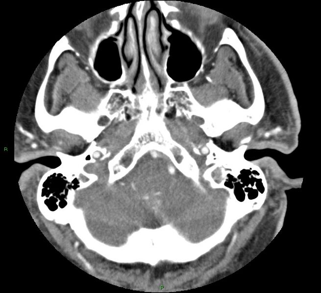 File:Brainstem hemorrhage (Radiopaedia 58794-66028 D 33).jpg