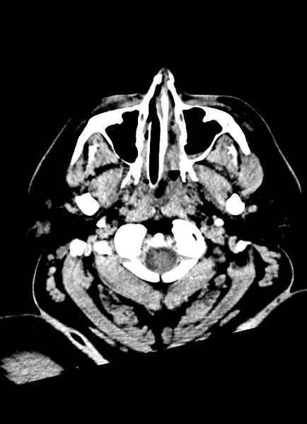 File:Brainstem hemorrhage (Radiopaedia 81294-94976 Axial non-contrast 60).jpg