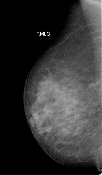 File:Breast microcalcifications - screening mammogram (Radiopaedia 5900-7453 MLO 1).jpg