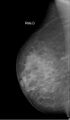 Breast microcalcifications - screening mammogram (Radiopaedia 5900-7453 MLO 1).jpg
