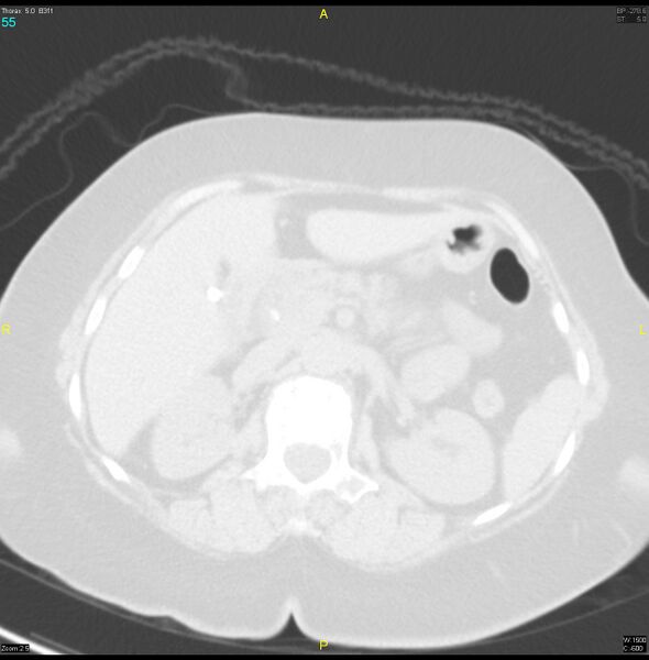 File:Breast primary with lung and bone metastases (Radiopaedia 40620-43228 Axial lung window 55).jpg