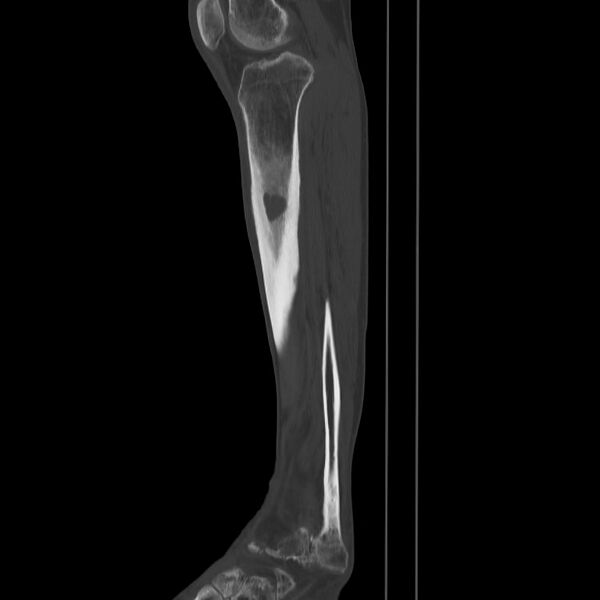 File:Brodie abscess - tibia (Radiopaedia 66028-75204 Sagittal bone window 46).jpg