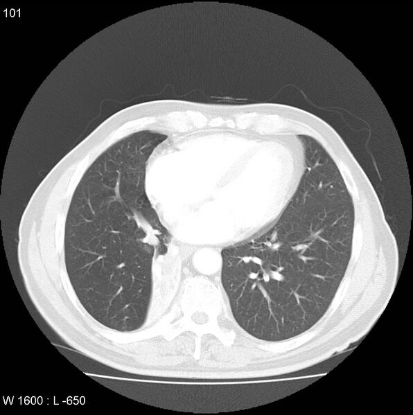 File:Bronchial carcinoid tumor with right lower lobe collapse (Radiopaedia 29060-29422 B 39).jpg