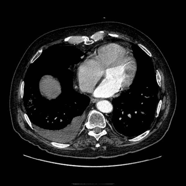 File:Bronchogenic adenocarcinoma and pulmonary embolism (Radiopaedia 9097-9806 D 43).jpg