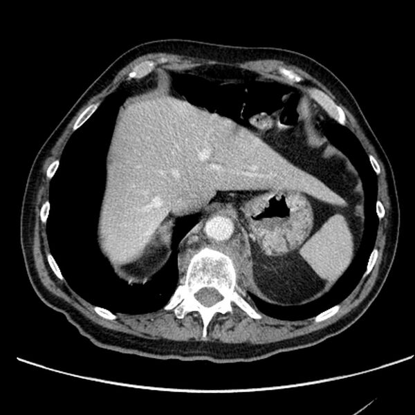 File:Bronchogenic carcinoma with L1 vertebra metastasis (Radiopaedia 9096-9805 Axial C+ delayed 30).jpg