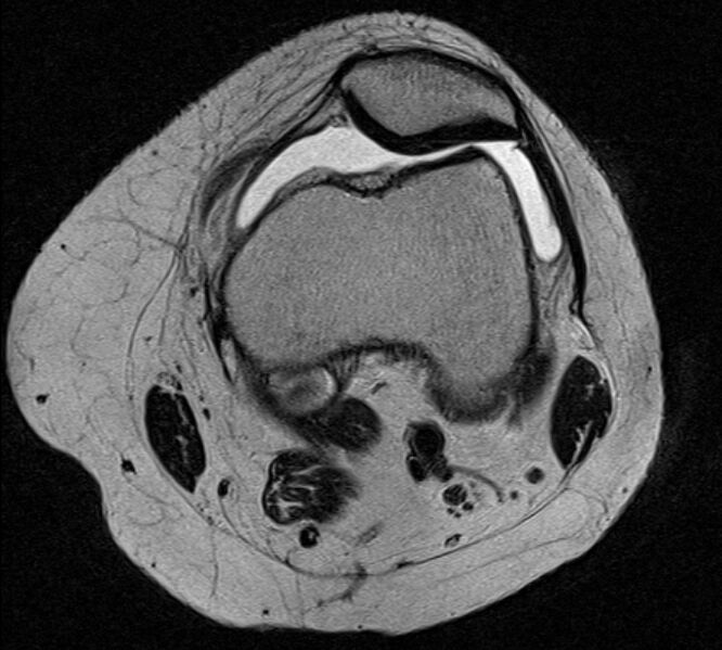 File:Bucket handle tear - medial meniscus (Radiopaedia 79028-91942 Axial T2 21).jpg