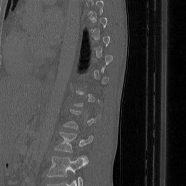 File:Bulging of paraspinal line in traumatic thoracal spinal compression fracture (Radiopaedia 29221-35872 Sagittal bone window 45).jpg
