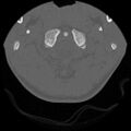 C5 facet fracture (Radiopaedia 58374-65499 Axial bone window 10).jpg
