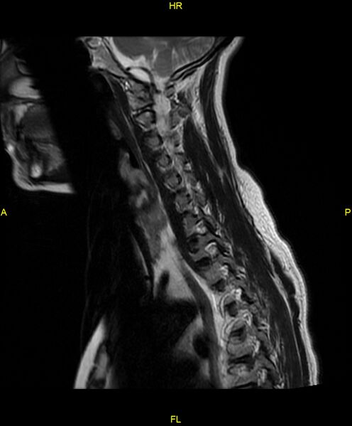 File:C5 nerve sheath tumor (Radiopaedia 85777-101596 Sagittal T2 13).jpg