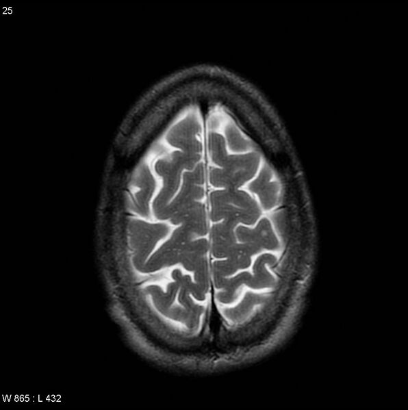 File:CMV ventriculitis and encephalitis (Radiopaedia 5416-7166 T2 7).jpg