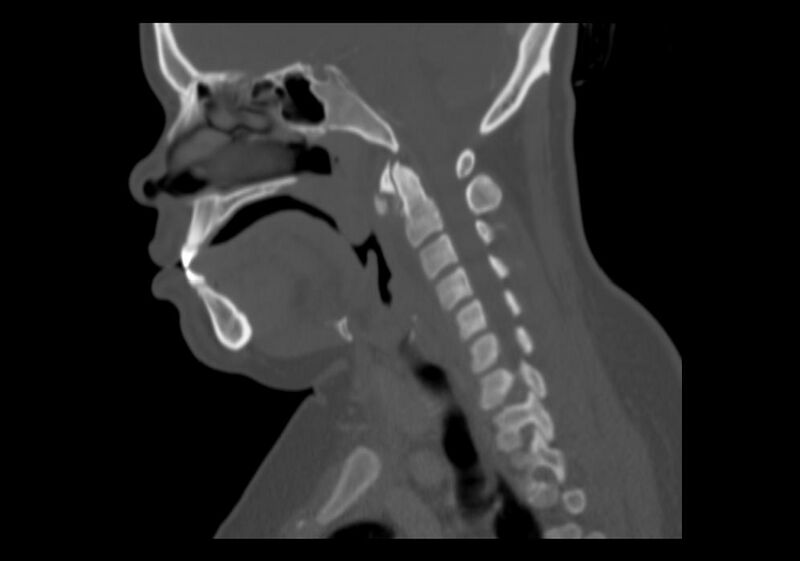 File:Calcific tendinitis of the longus colli muscle (Radiopaedia 28113-28371 Sagittal bone window 10).jpg