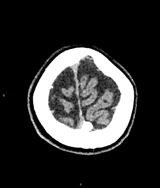 File:Calcified cerebral emboli from left ventricular thrombus (Radiopaedia 84420-99758 Axial non-contrast 12).jpg