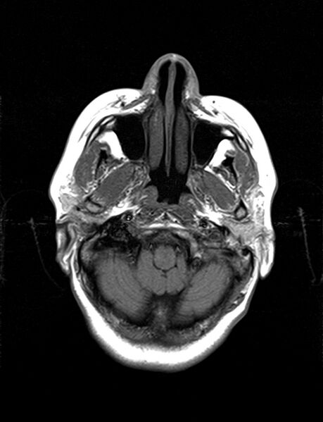 File:Calcified cerebral hydatid cyst (Radiopaedia 65603-74699 Axial T1 3).jpg