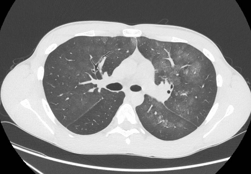 File:Cannabis-induced diffuse alveolar hemorrhage (Radiopaedia 89834-106946 Axial lung window 45).jpg