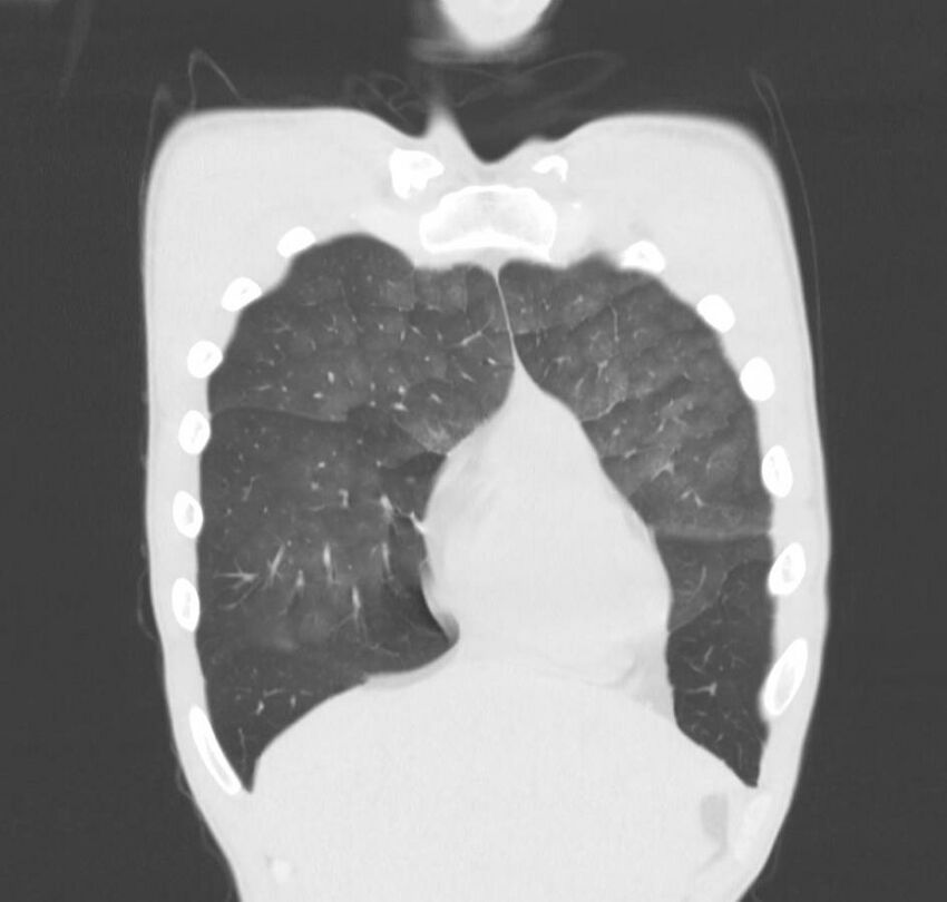Cannabis-induced diffuse alveolar hemorrhage (Radiopaedia 89834-106946 Coronal lung window 73).jpg