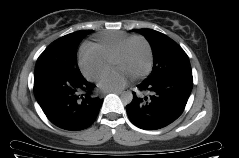 File:Cannonball metastases - uterine choriocarcinoma (Radiopaedia 70137-80173 Axial non-contrast 71).jpg