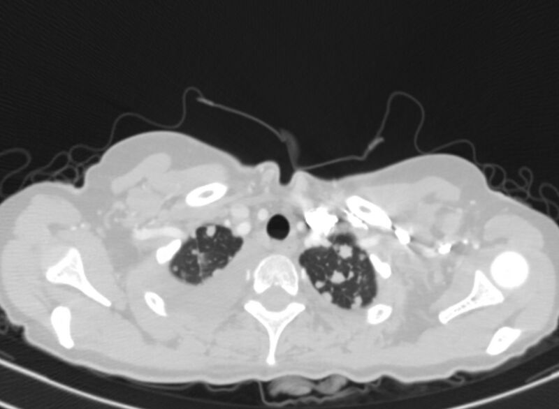 File:Cannonball metastases from breast cancer (Radiopaedia 91024-108569 Axial lung window 6).jpg