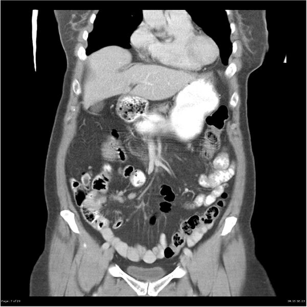 File:Carcinoid tumor of the ileum with metastasis to orbit (Radiopaedia 28165-28425 B 7).jpg
